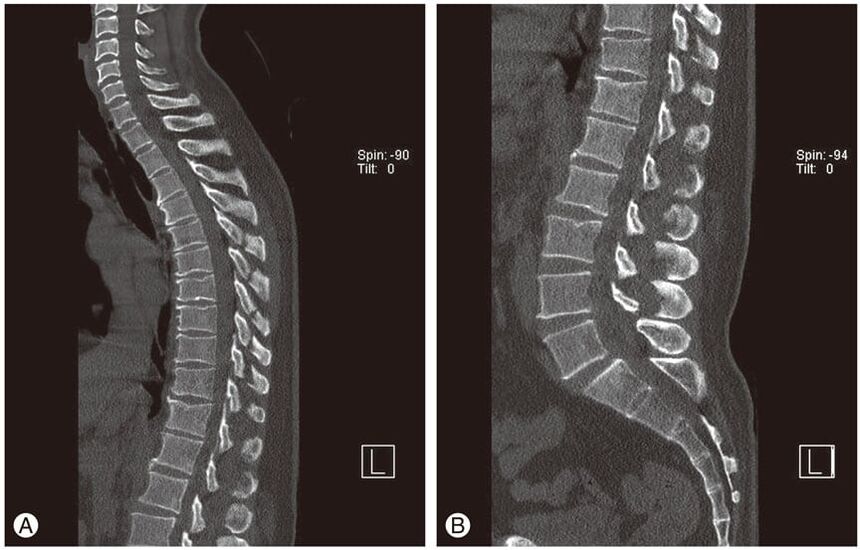 Deformacja krążków międzykręgowych na obrazach MRI w osteochondrozie klatki piersiowej