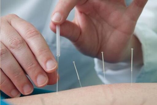 Akupunktura – metoda leczenia bólu w okolicy lędźwiowej wywołanego osteochondrozą