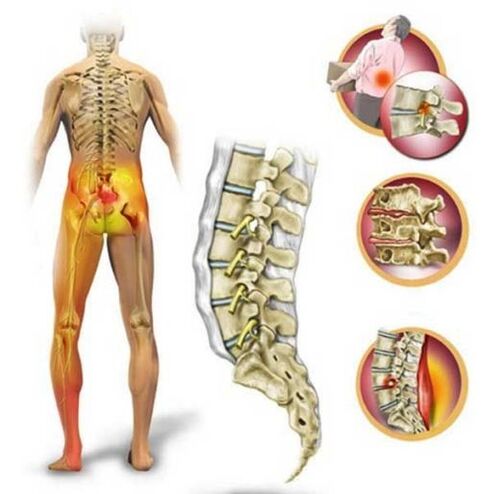 Osteochondroza kręgosłupa lędźwiowego, powodująca ból pleców