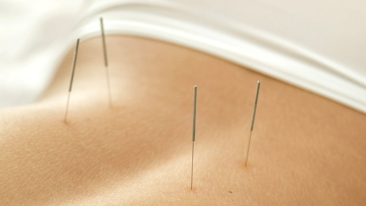 Akupunktura pomoże pozbyć się bólu dolnej części pleców