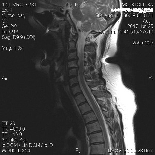 Dyskopatia i spondylozą kręgosłupa szyjnego